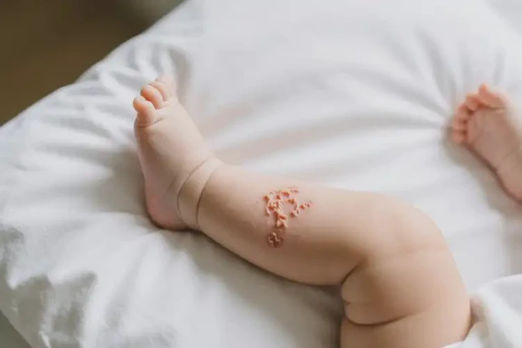 小兒大腿長濕疹不管它會自己自愈嗎(圖2)