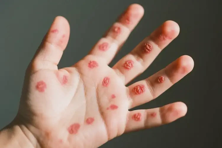 小孩手上出現(xiàn)濕疹能夠徹底治愈嗎(圖4)