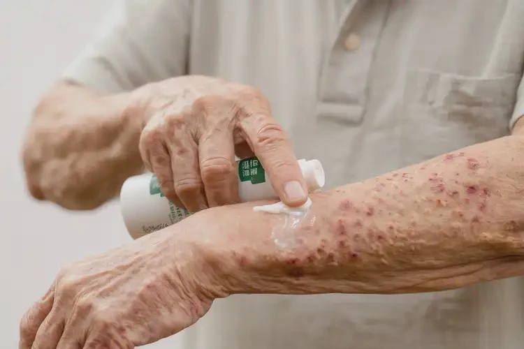 老年人手臂有濕疹能徹底自愈嗎(圖3)