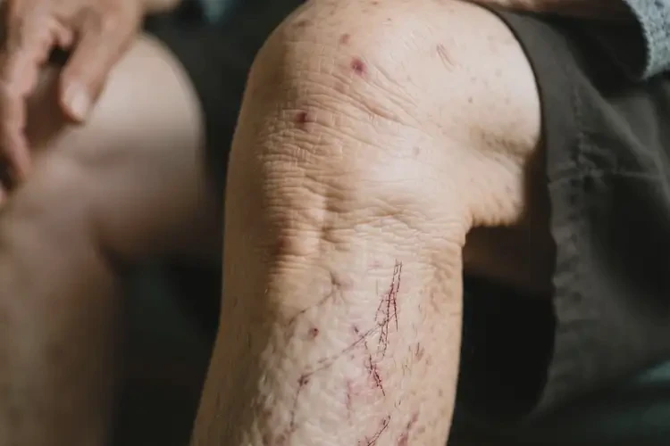 老年人小腿上經(jīng)常長濕疹能靠自己自愈嗎(圖1)