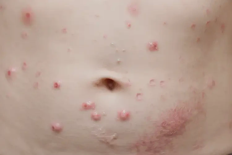 小學生肚子上長濕疹能夠徹底治愈嗎(圖4)