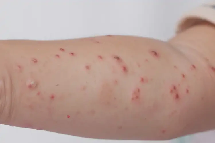 孩子全身容易長濕疹能徹底自愈嗎(圖4)