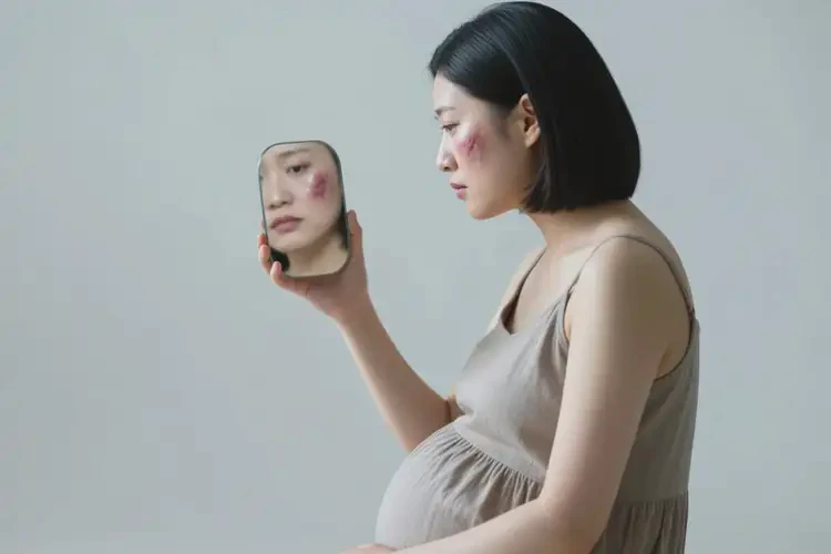 產(chǎn)婦面部經(jīng)常起濕疹不管它會自己自愈嗎(圖2)