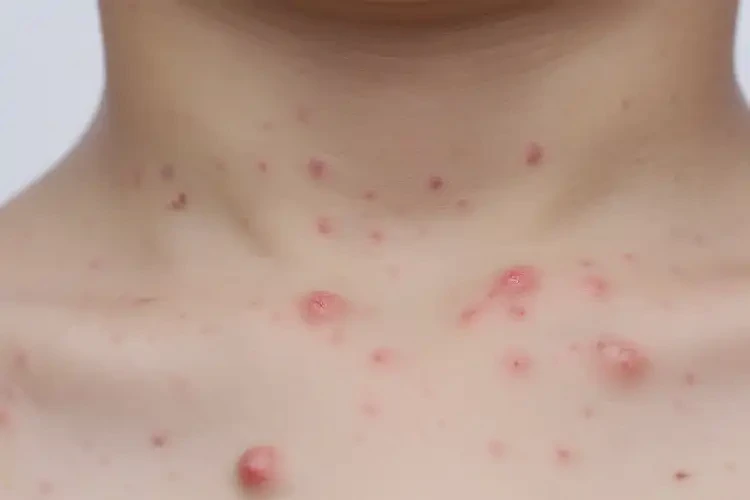 小學(xué)生脖子上經(jīng)常長(zhǎng)濕疹能徹底自愈嗎(圖4)