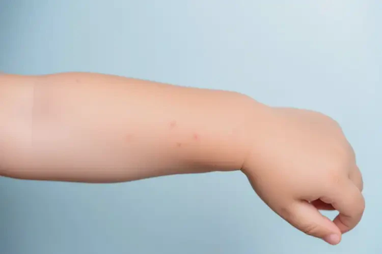 少兒手臂起濕疹能徹底自愈嗎(圖4)