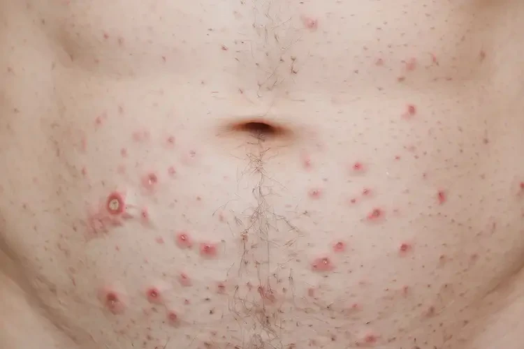 男人肚子經(jīng)常長濕疹能夠徹底治愈嗎(圖4)