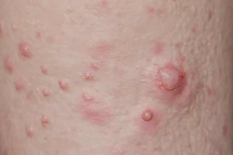 男生脖子上長(zhǎng)濕疹不管它會(huì)自己痊愈嗎(圖3)