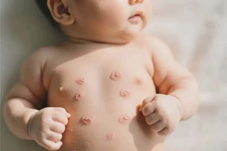嬰幼兒身上經(jīng)常長(zhǎng)濕疹不管它會(huì)自己痊愈嗎(圖2)