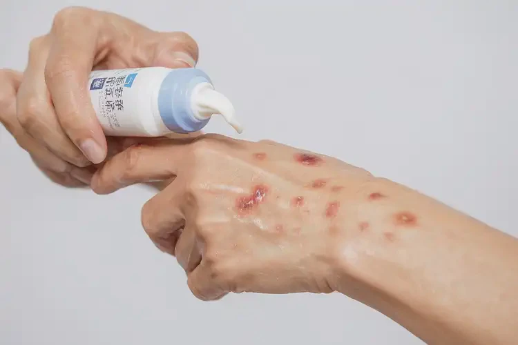 女生手上容易長濕疹能徹底自愈嗎(圖3)