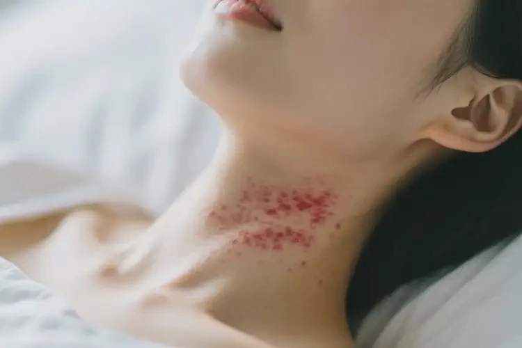 女性脖子上偶爾長濕疹不管它會自己痊愈嗎(圖1)