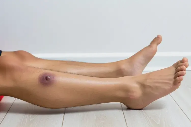 青年人小腿上出濕疹不管它會(huì)自己自愈嗎(圖2)