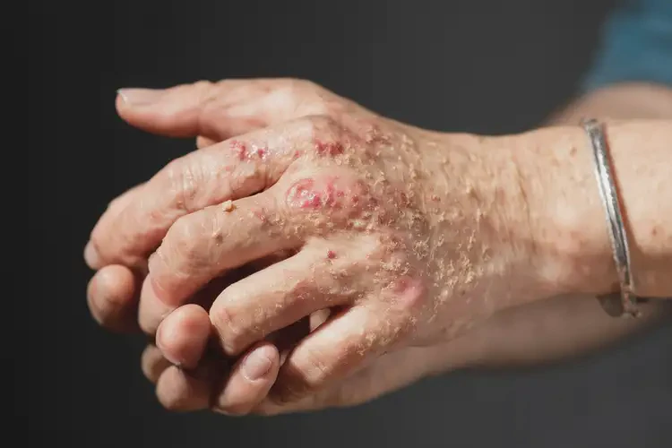 女人全身經(jīng)常起濕疹不管它會(huì)自己自愈嗎(圖4)