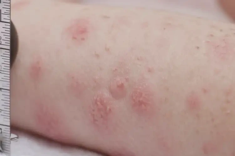 婴儿肛周出现湿疹可以彻底自愈吗(图4)