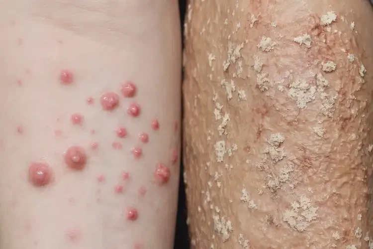 男生脖子上偶爾長(zhǎng)濕疹可以徹底自愈嗎(圖3)