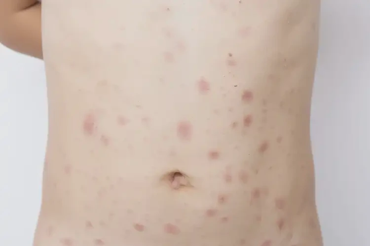中學(xué)生肚子上起濕疹不管它會自己痊愈嗎(圖4)