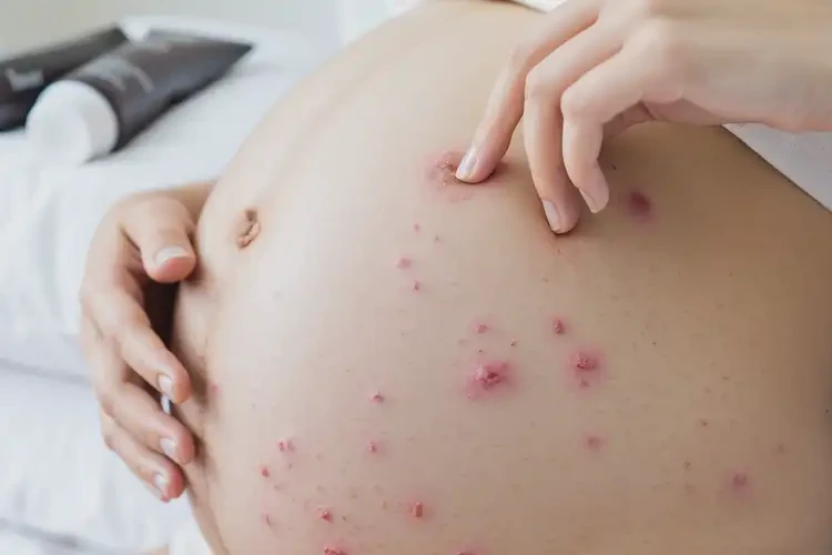 孕婦屁股經(jīng)常長濕疹不管它會自己自愈嗎(圖4)