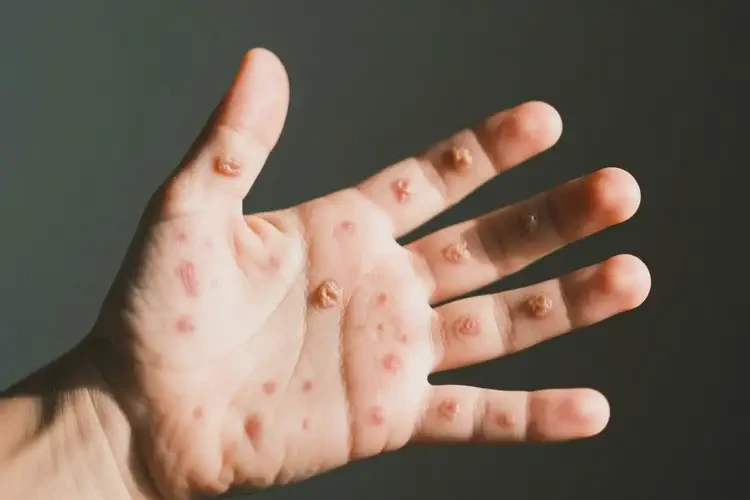 小孩手上出現(xiàn)濕疹能夠徹底治愈嗎(圖1)