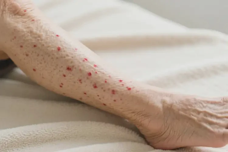 老人大腿上偶爾起濕疹可不可以徹底自愈(圖2)