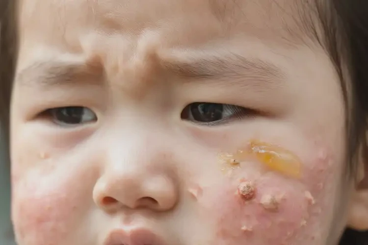 寶寶面部出濕疹能靠自己自愈嗎(圖3)