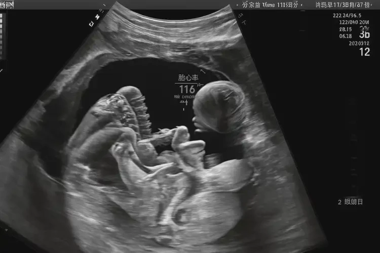 孕33周6天胎心116正常嗎(圖4)