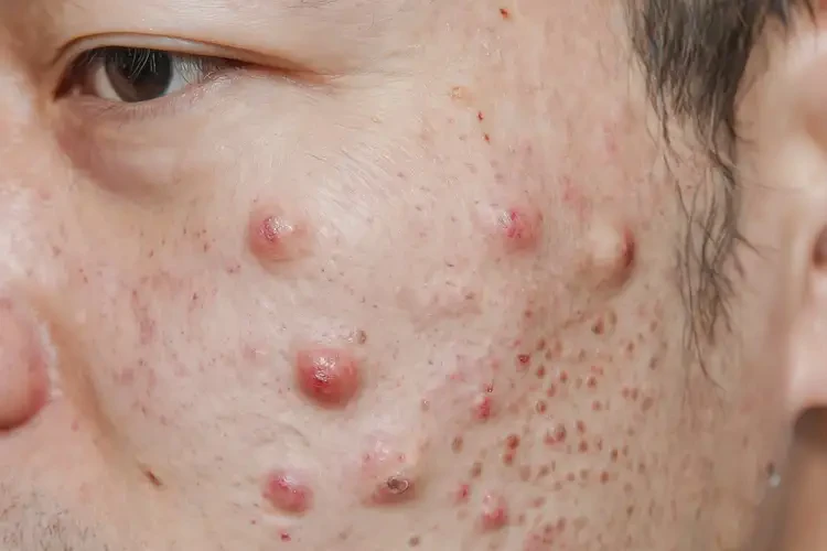 青年人面部出現(xiàn)濕疹不管它會(huì)自己好嗎(圖4)