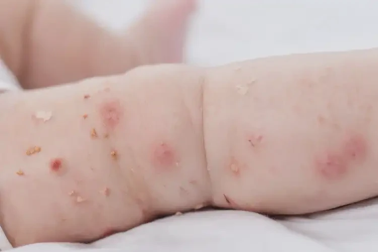 宝宝四肢出现湿疹不管它会自己痊愈吗(图4)