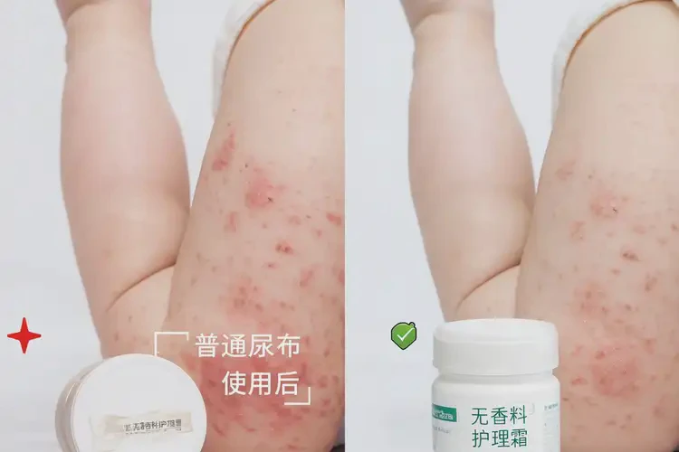 少兒屁股起濕疹能徹底自愈嗎(圖2)