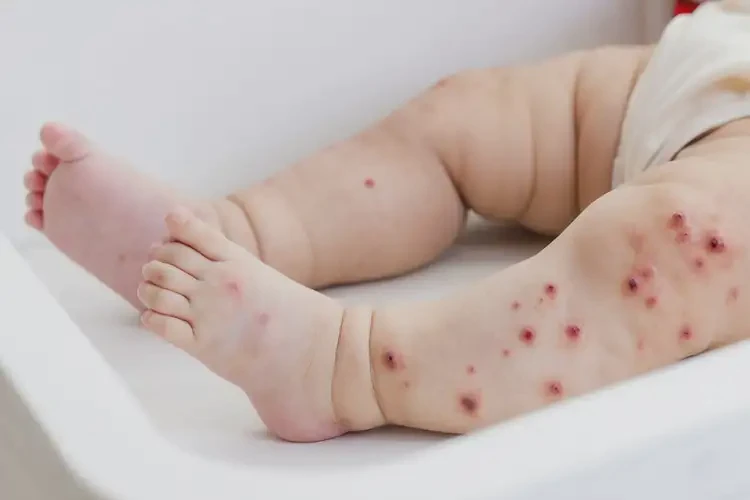 嬰兒四肢偶爾長濕疹可以徹底自愈嗎(圖4)