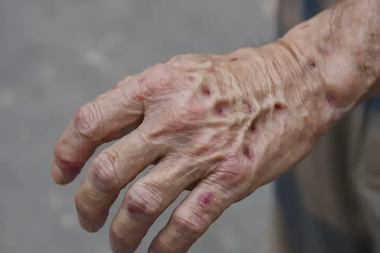 老年人手上經(jīng)常長濕疹不管它會(huì)自己痊愈嗎(圖4)