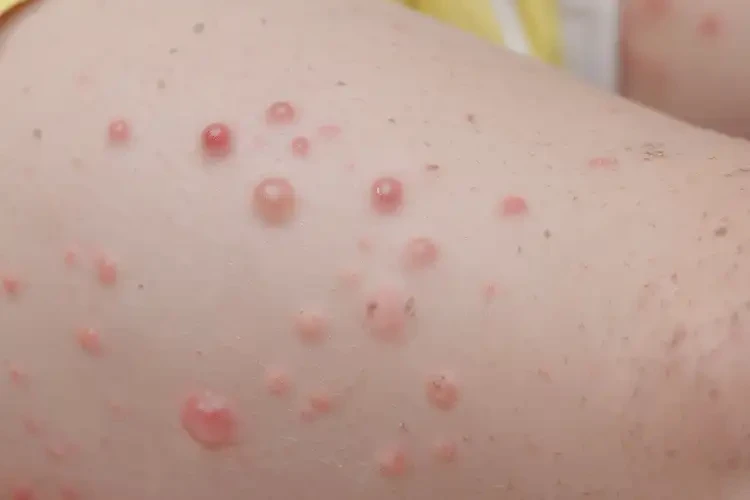 儿童小腿上容易长湿疹可以彻底自愈吗(图4)