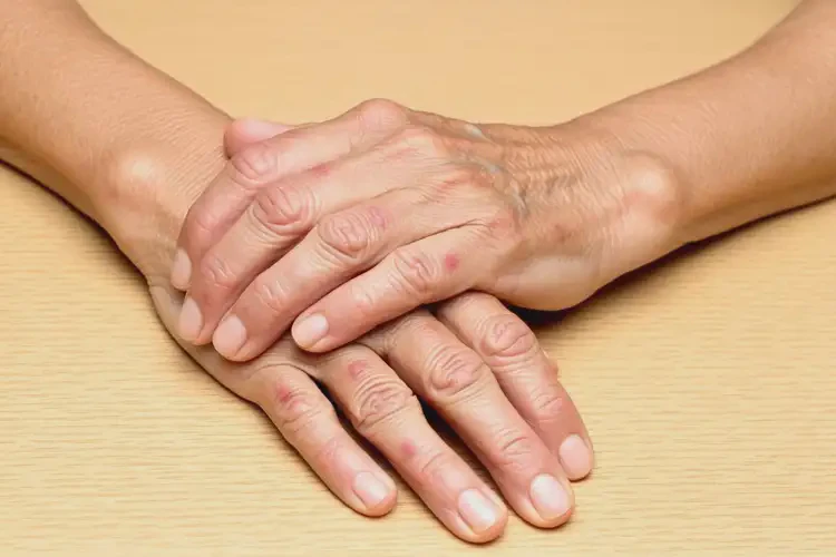 高齡老人手上出濕疹能徹底自愈嗎(圖4)