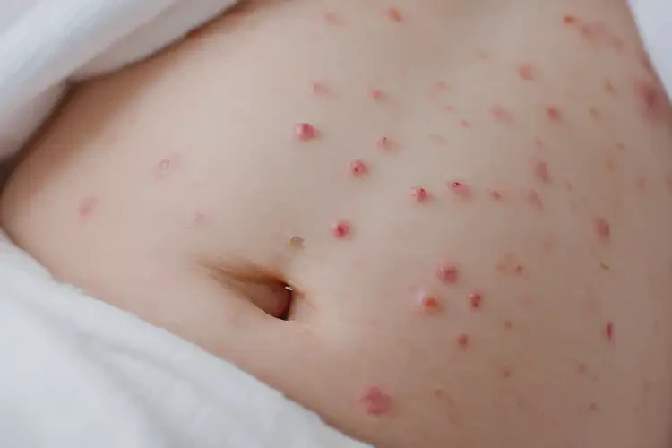 新生兒肚子上偶爾起濕疹可以徹底自愈嗎(圖4)