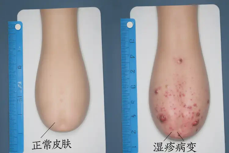 小兒肛周經(jīng)常長濕疹不管它會自己痊愈嗎(圖1)