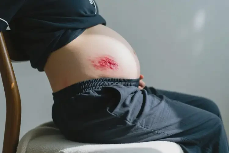 產(chǎn)婦屁股上容易長濕疹不管它會自己好嗎(圖1)