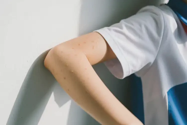 中學(xué)生手臂上偶爾起濕疹可以徹底自愈嗎(圖2)