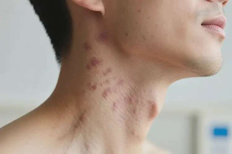 男人脖子有濕疹能不能徹底自愈(圖1)