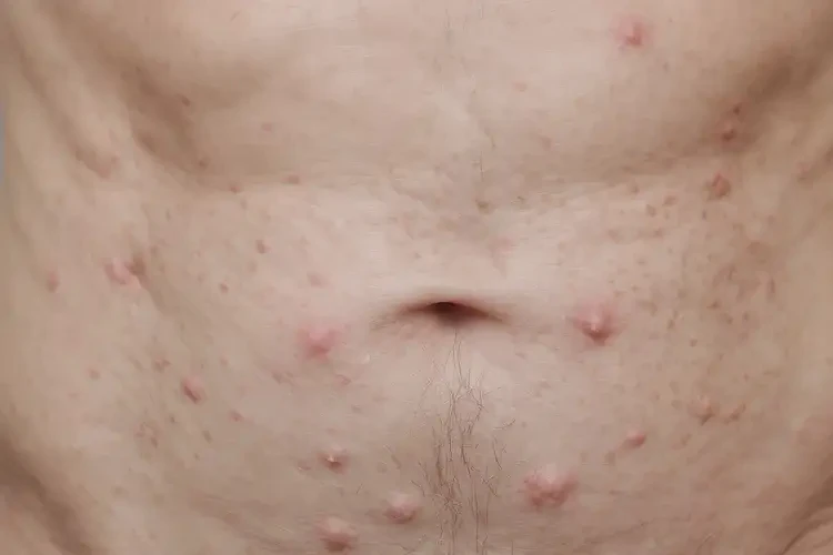 男人肚子偶爾起濕疹能不能徹底自愈(圖4)