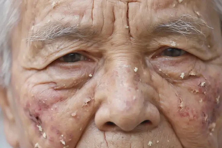 老年人臉上有濕疹可以徹底自愈嗎(圖4)