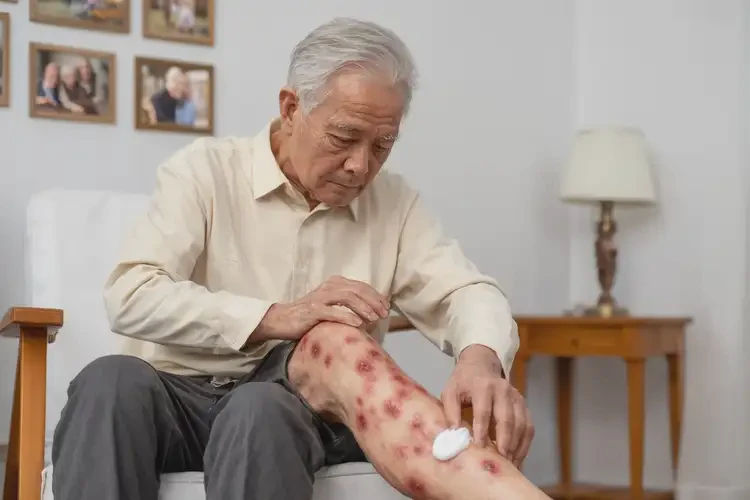 高齡老人小腿起濕疹不管它會自己自愈嗎(圖2)
