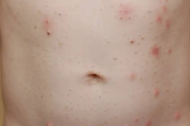 小孩肚子有濕疹可以徹底自愈嗎(圖4)