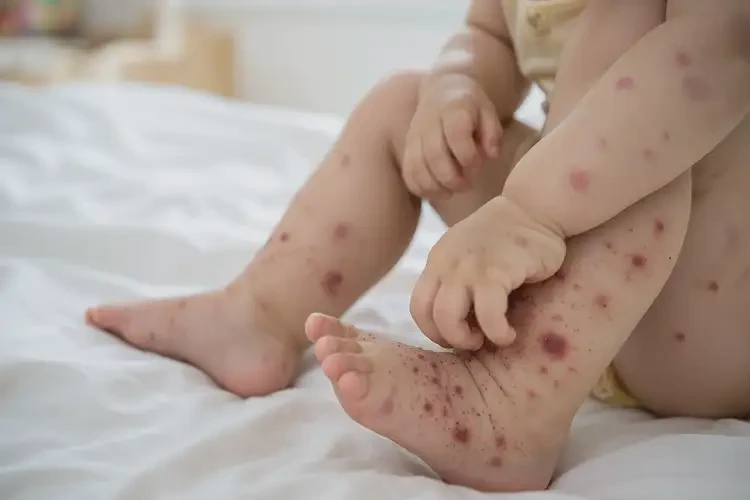 幼兒大腿上出現(xiàn)濕疹能不能徹底自愈(圖4)