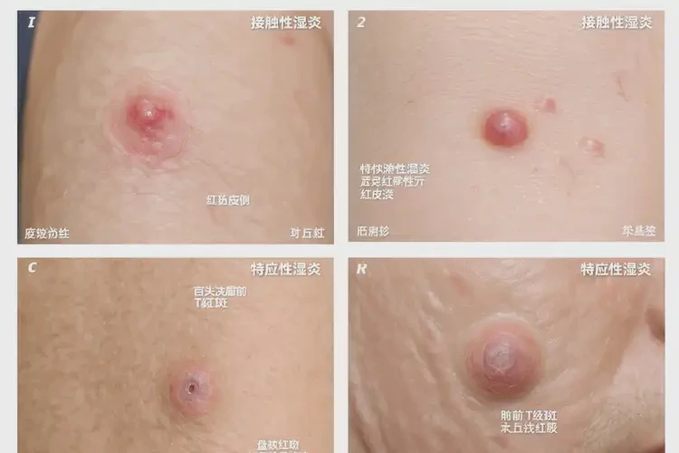 老人脖子偶爾長濕疹不管它會自己痊愈嗎(圖3)