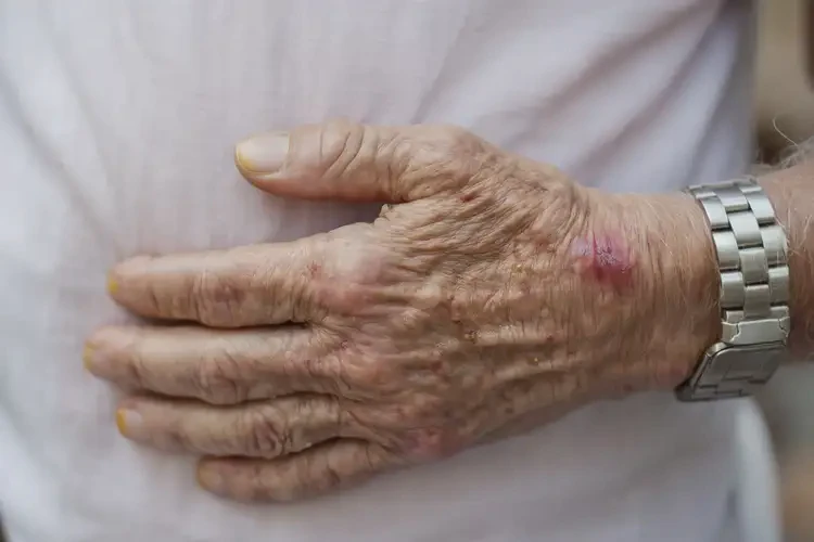 高齡老人手上長(zhǎng)濕疹不管它會(huì)自己痊愈嗎(圖4)