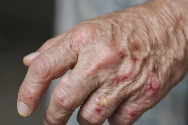 老年人四肢偶爾起濕疹能不能徹底自愈(圖4)