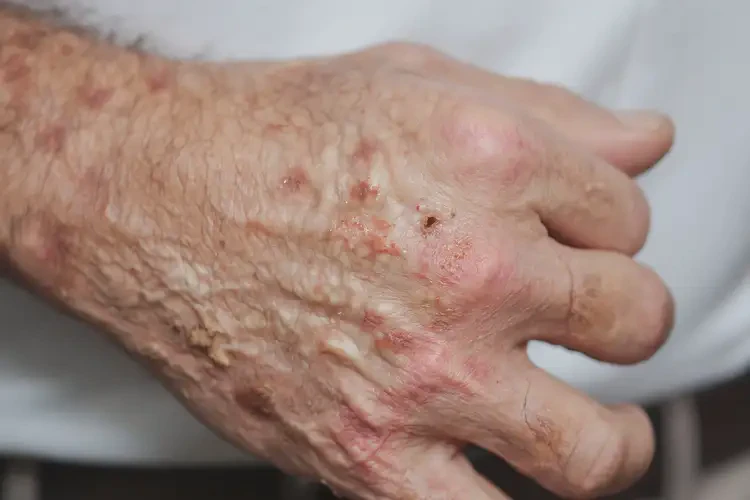 男性手上出現(xiàn)濕疹可以徹底自愈嗎(圖4)