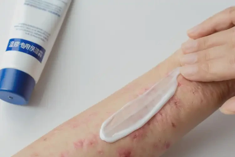 大學(xué)生手上偶爾起濕疹不管它會(huì)自己自愈嗎(圖3)