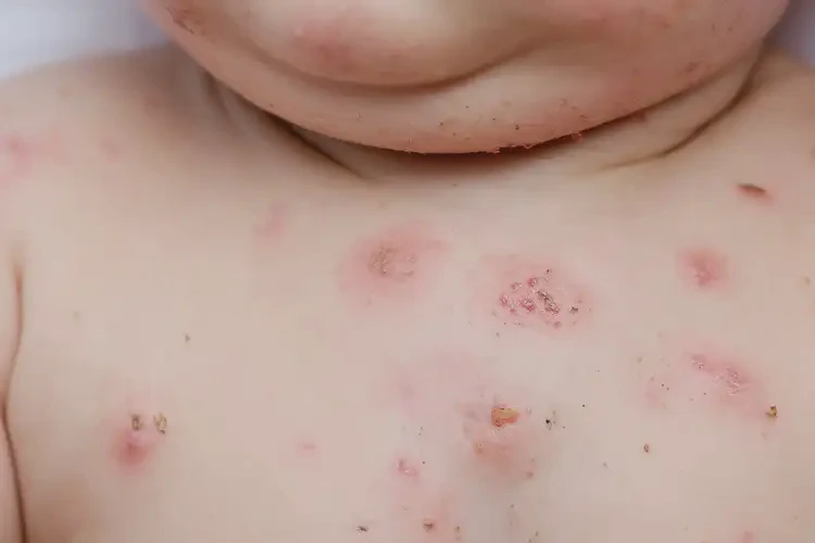 婴幼儿脖子上起湿疹能彻底自愈吗(图4)