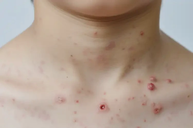 中學(xué)生脖子容易起濕疹不管它會自己好嗎(圖4)
