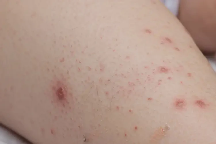 幼儿大腿容易长湿疹可以彻底自愈吗(图4)