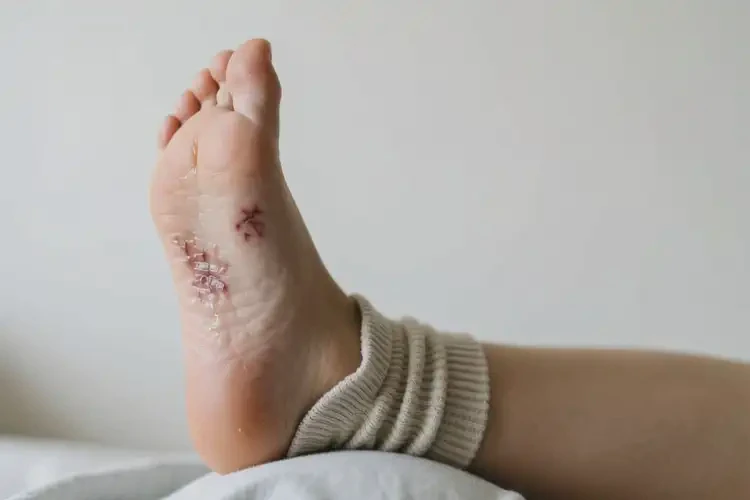 產(chǎn)婦腳上經(jīng)常起濕疹不管它會自己好嗎(圖3)